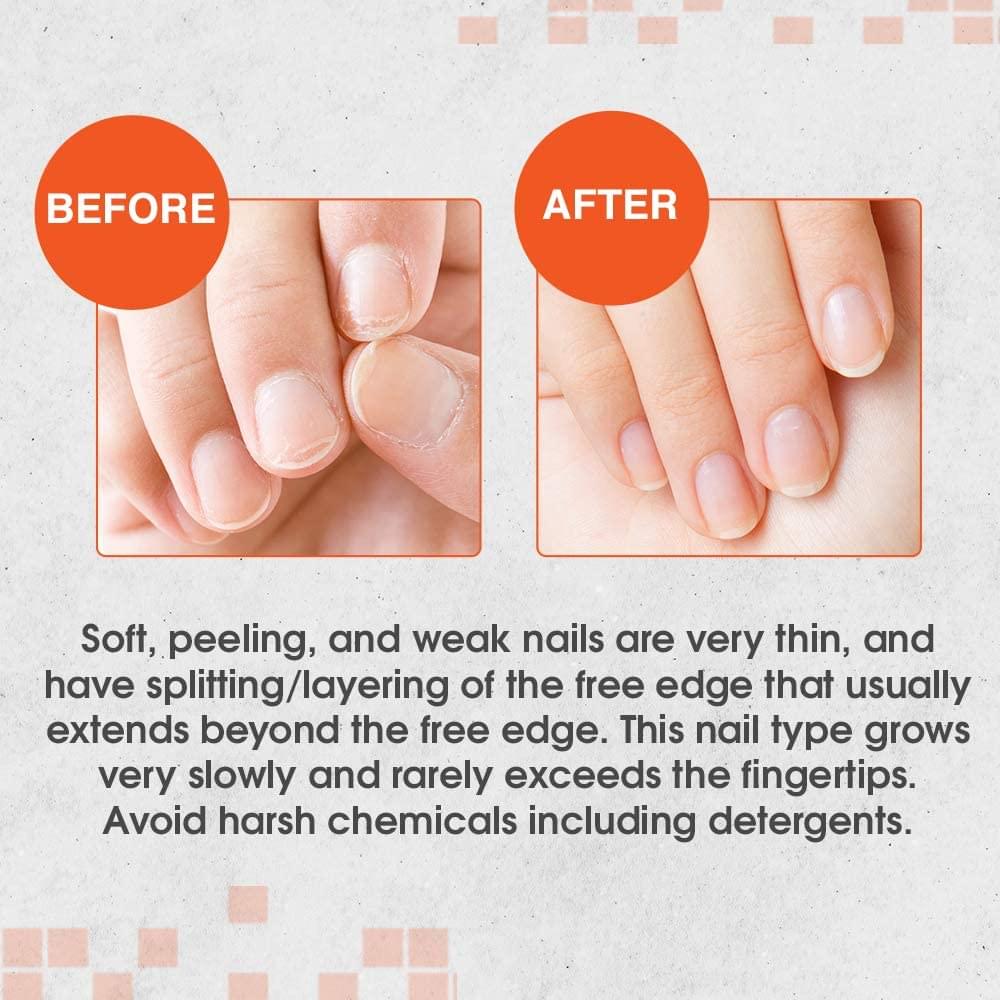 Home Remedies for Brittle Nails