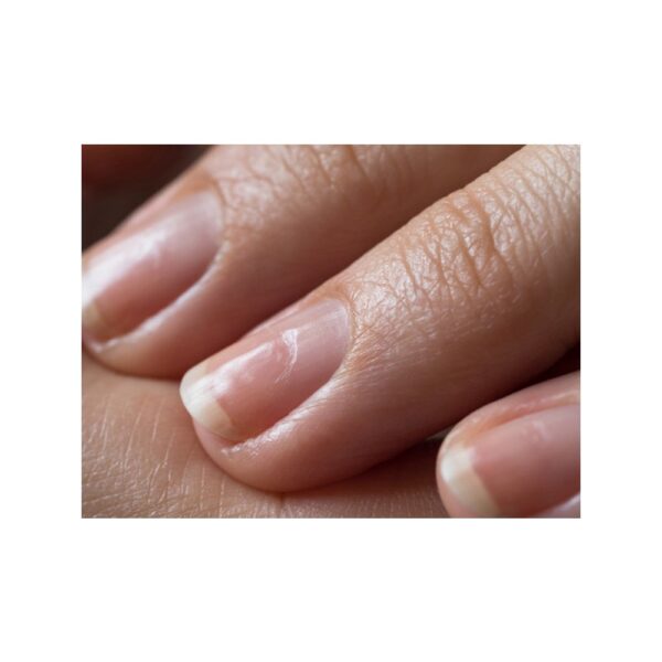Damaged nails after gel polish.